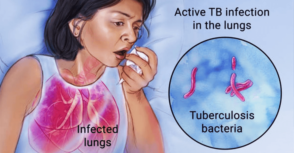 tuberculosis-types-symptoms-causes-transmission-and-treatment