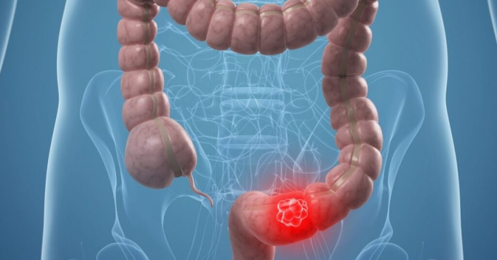 Common Symptoms of Colon Cancer You Shouldn’t Ignore