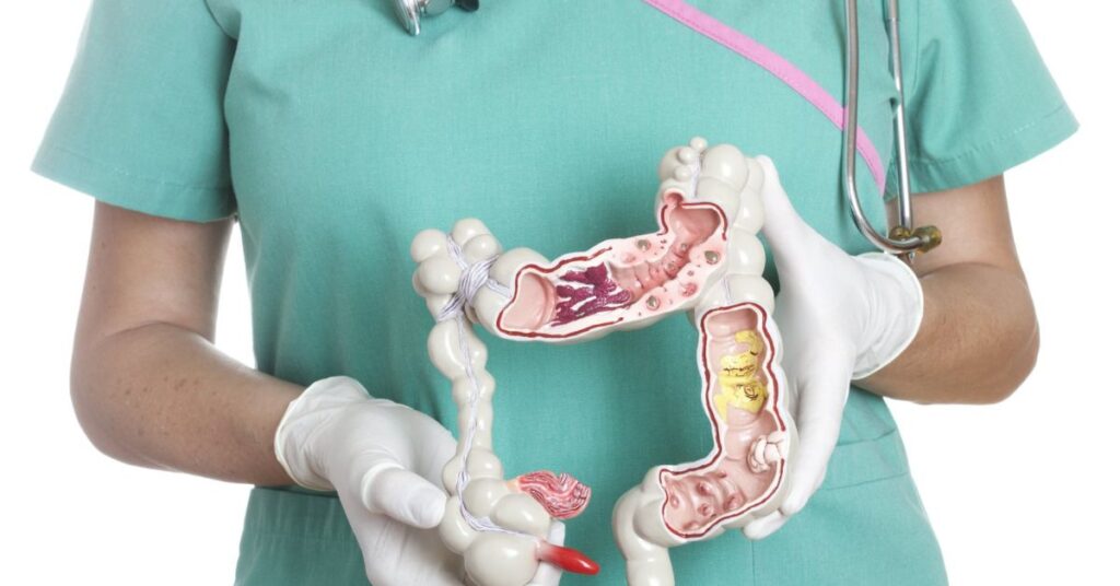 surgery-for-colon-cancer